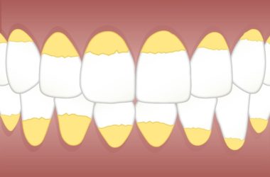 Jak vyzrát na zubní kámen